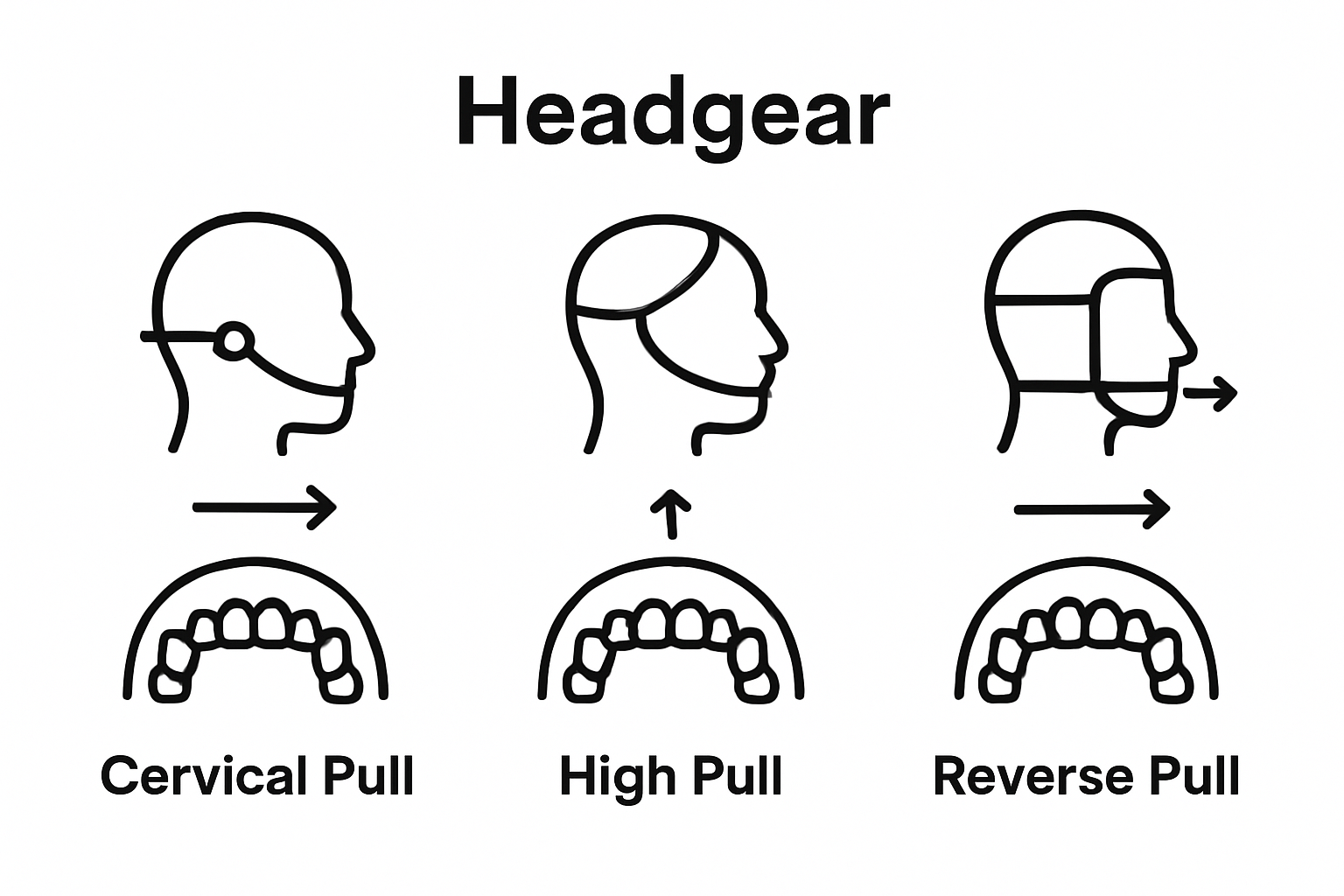 Infographic comparing types of orthodontic headgear and directional force