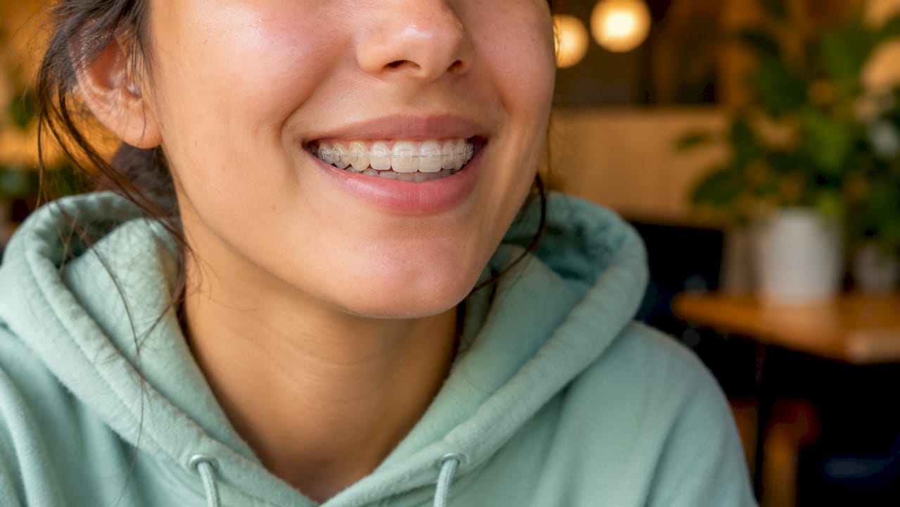 Close-up of smile with clear dental aligners