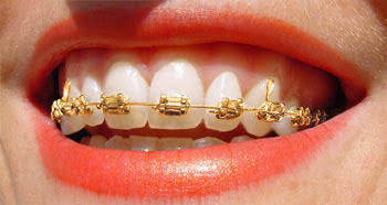 gold braces