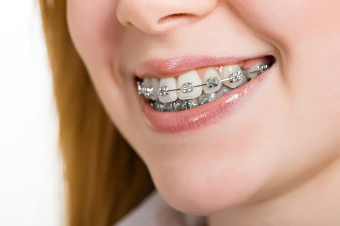 stainless steel brackets, silver brackets