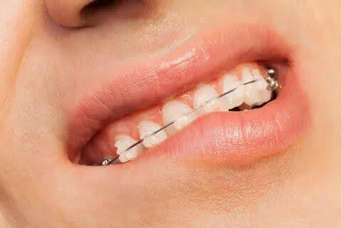 braces