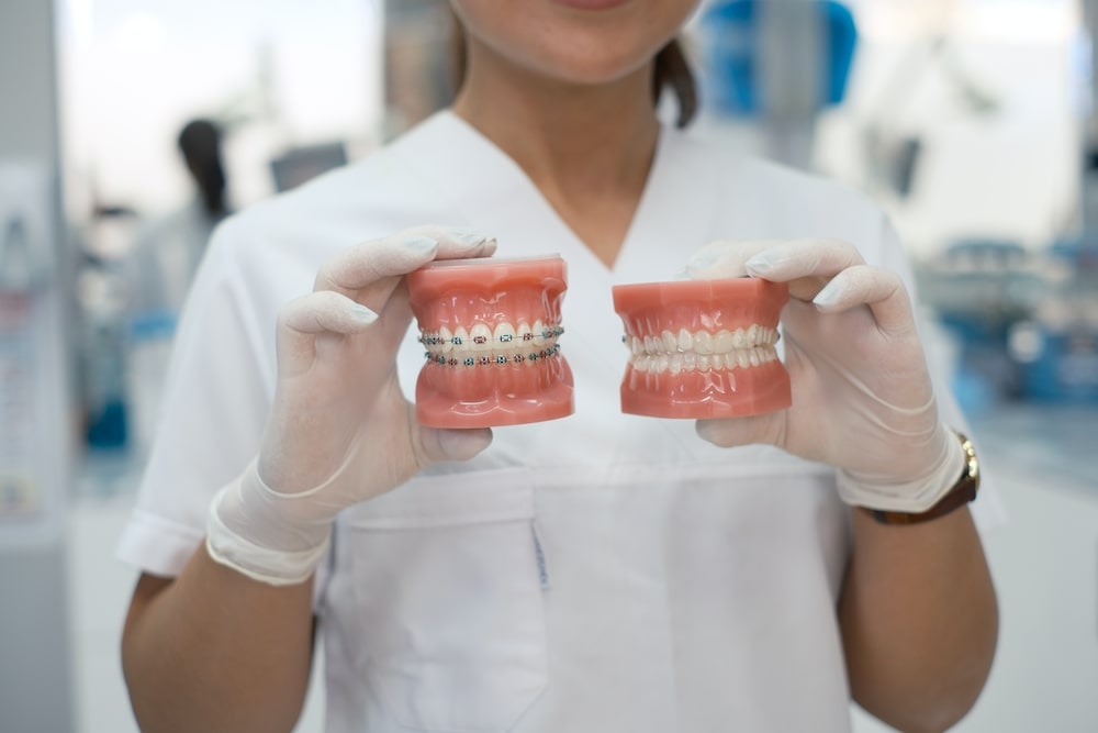 braces molds