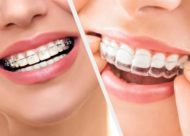 traditional braces, wires, clear aligners