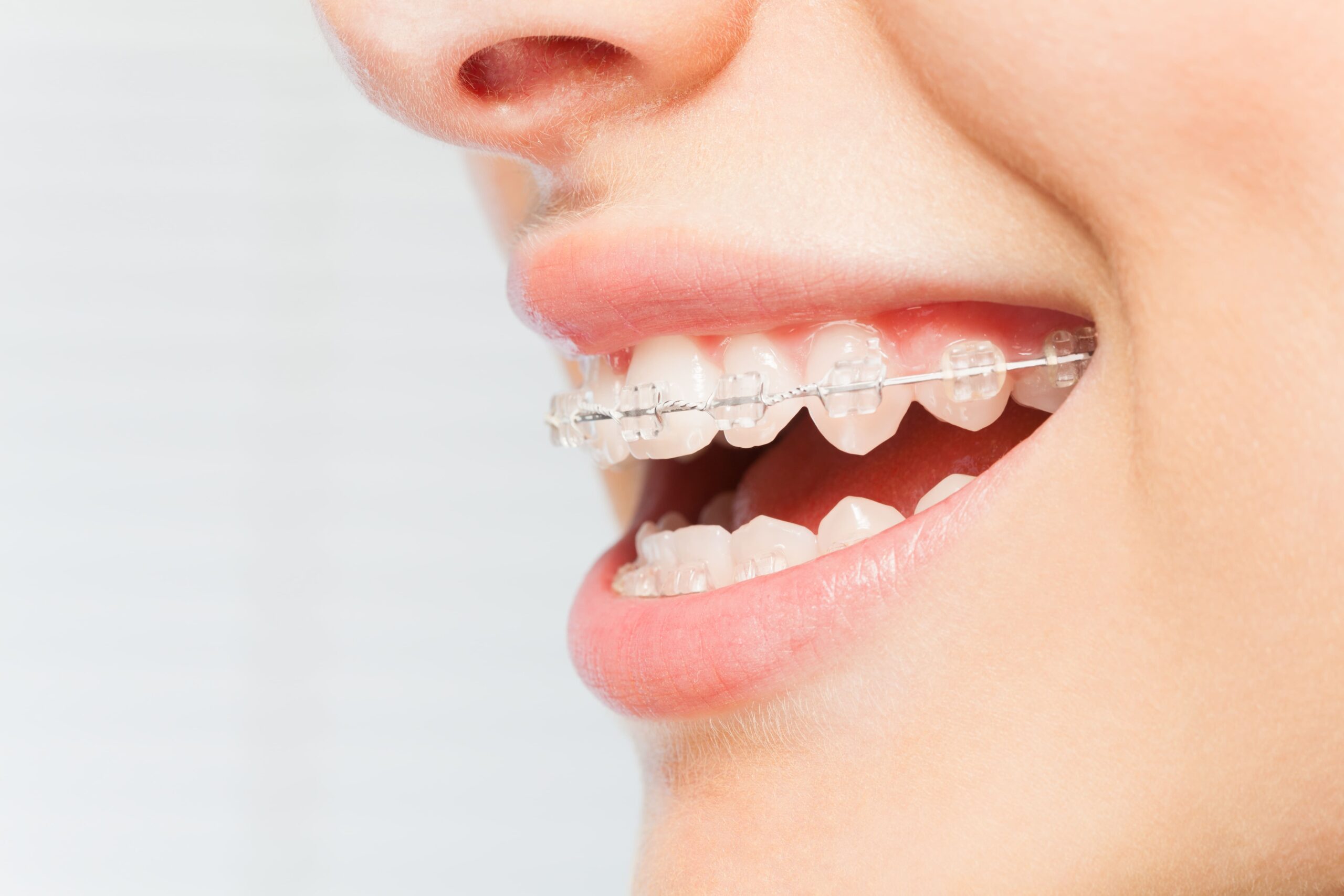 clear braces Langley BC